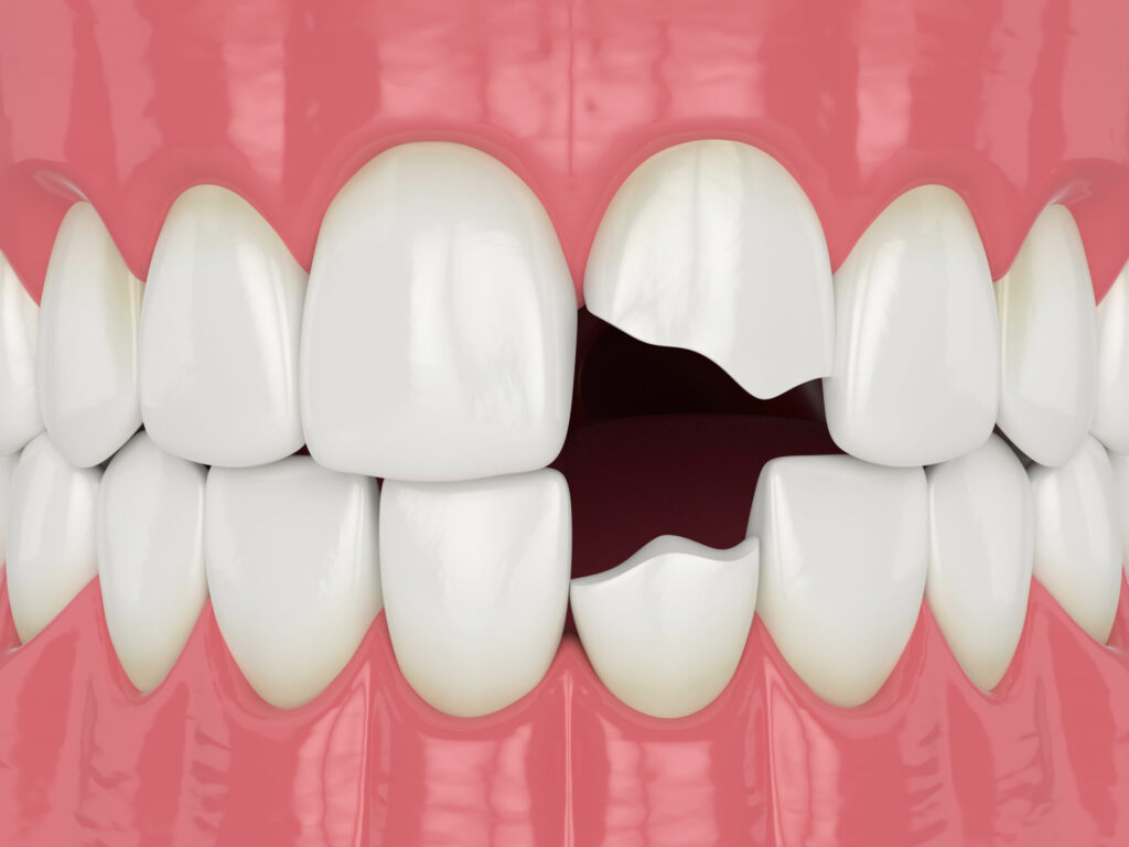 7 Options To Fix a Broken Tooth