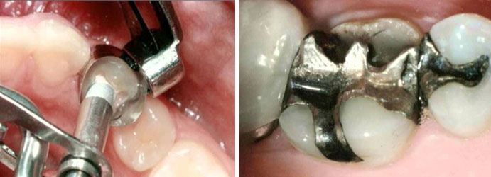 Amalgam Filling