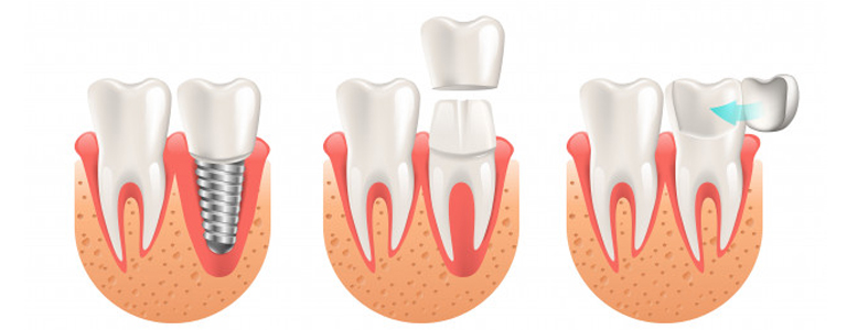 Best Cavities Service