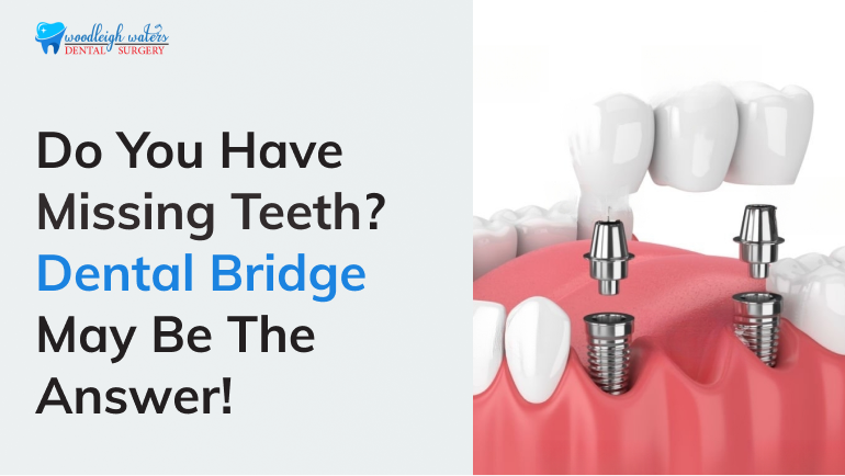 Dental Bridge