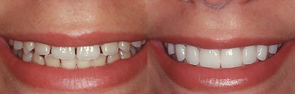 Composite Veneer Procedure Before After