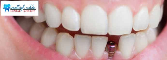Dental Implants