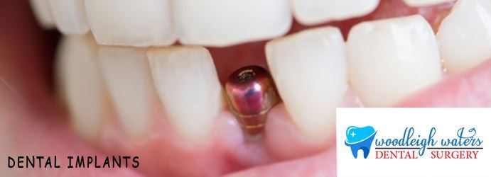 Dental Implants