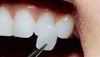 Dental Veneers