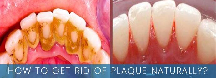 How to Get Rid of Plaque Naturally?