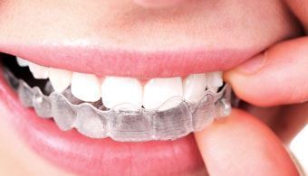 Invisalign