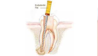 Root Canal Therapy