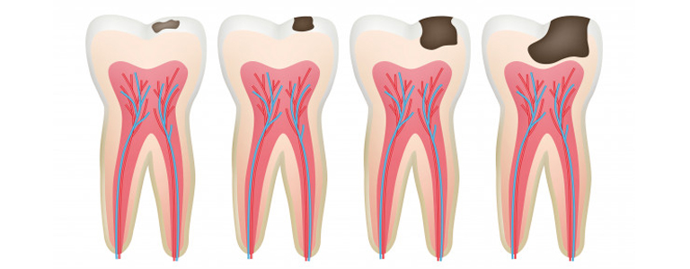 Root Canal Treatment