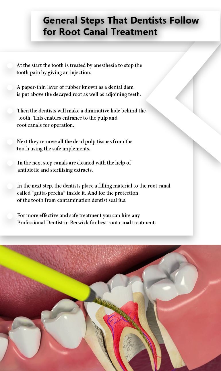 root canal treatment