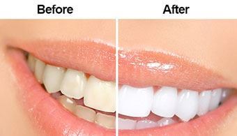 Scaling and Cleaning