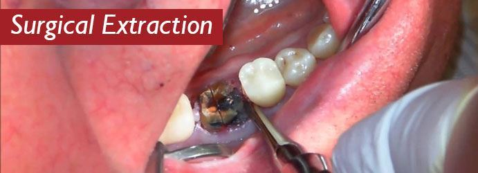 Definition Of Tooth Surgical Extraction