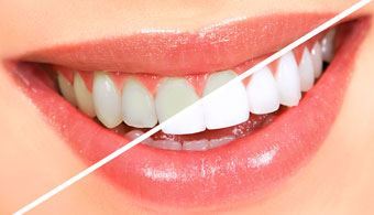 Teeth Whitening