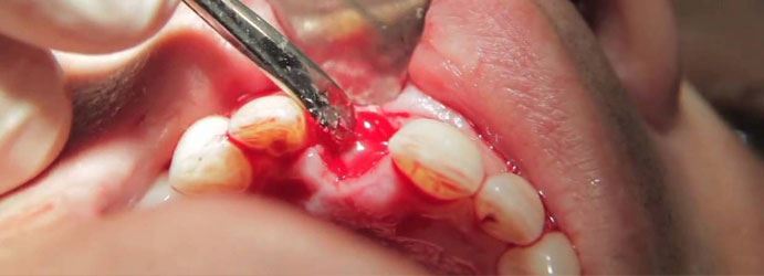 tooth extraction meaning