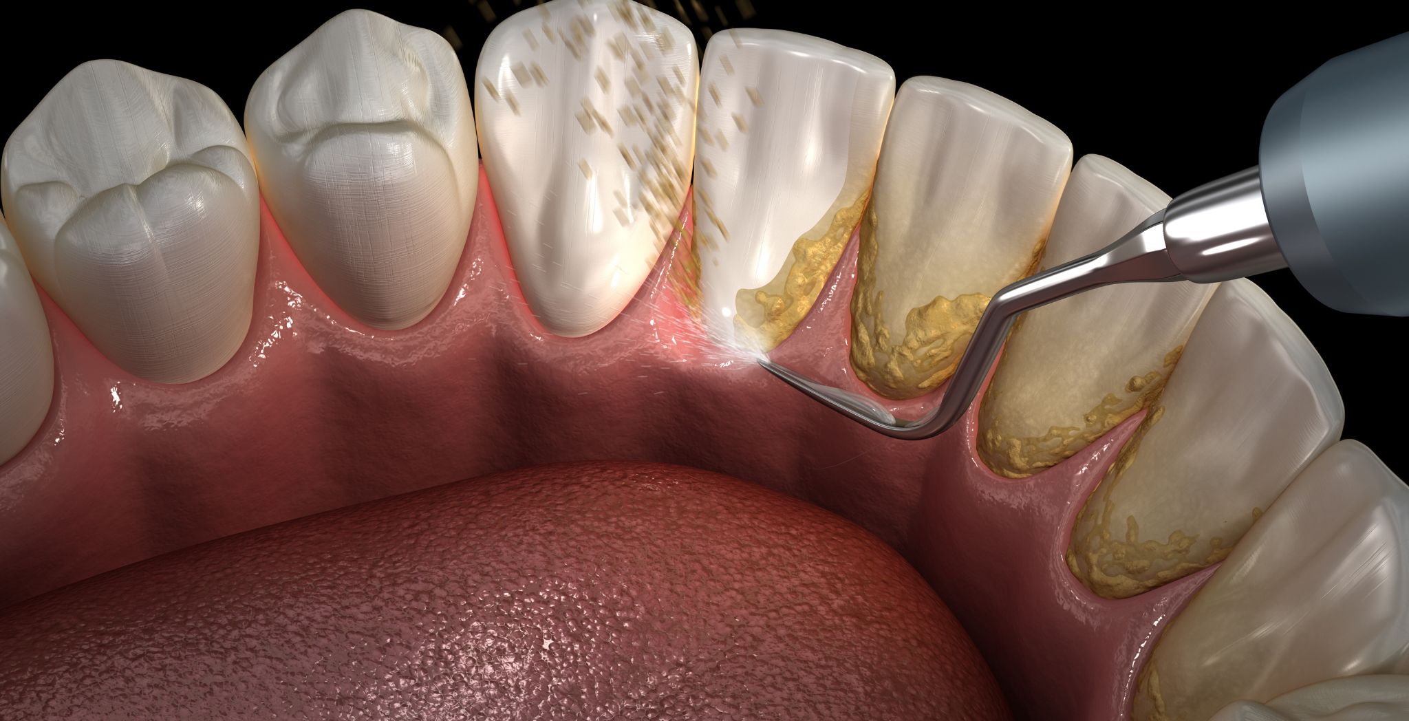 Removing dental plaque, Plaque removal from teeth, How to clean dental plaque, Professional plaque cleaning, Dental hygiene plaque control, Plaque buildup treatment, Brushing to remove plaque