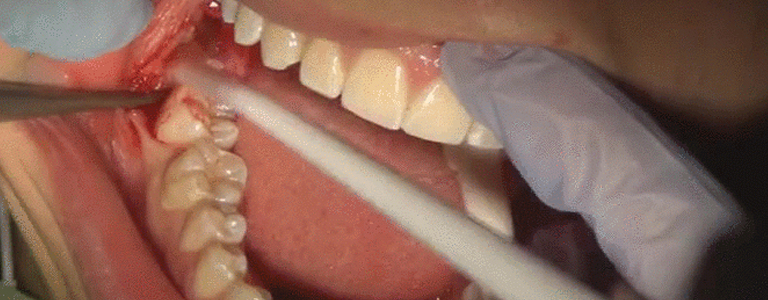 Wisdom Teeth Removed