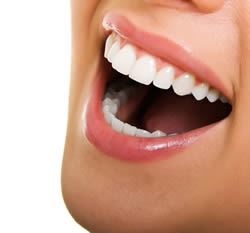 bleached-teeth