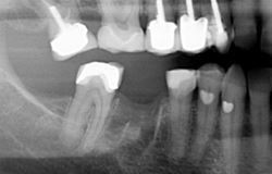 bridge-xray