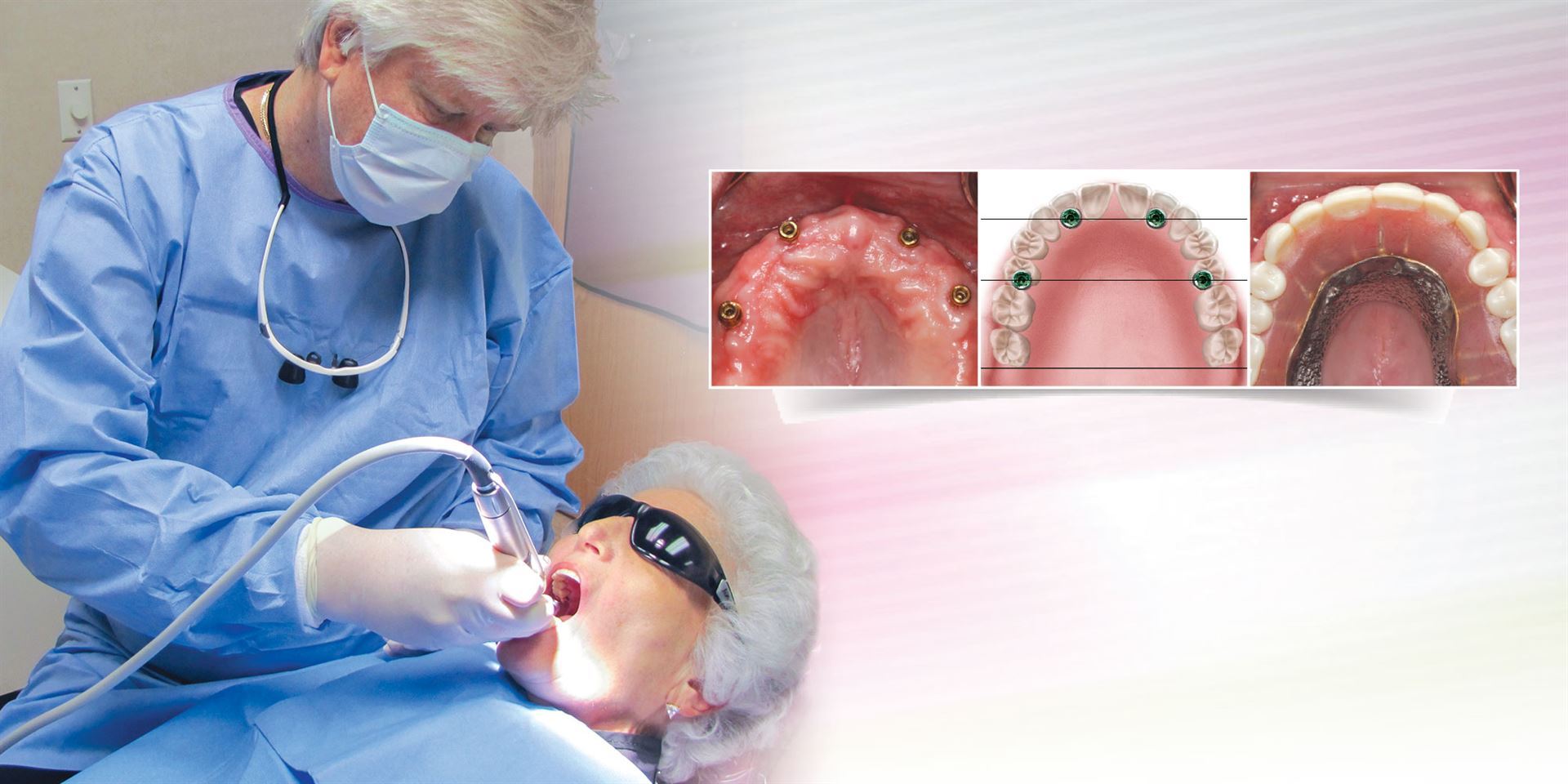 Which Indicate That You Might Need Dentures