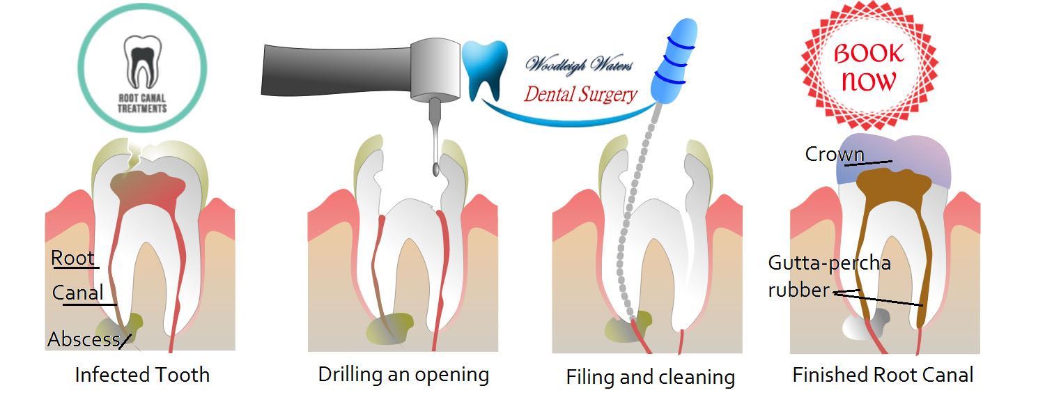 Root canal treatmenrt in berwick