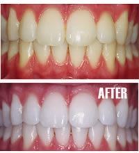 tooth-bleaching